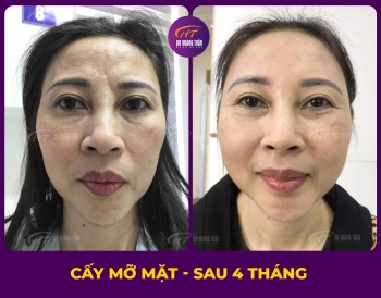 CẤY MỠ